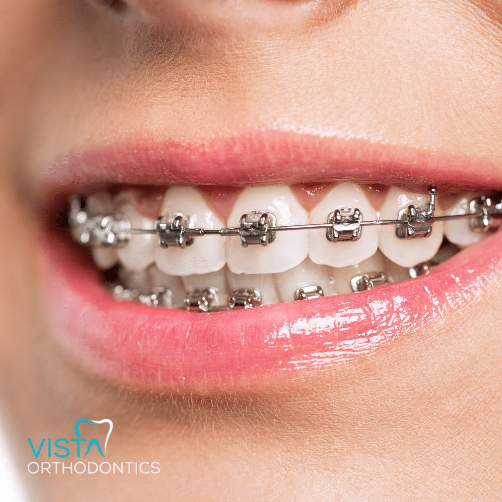 Braces