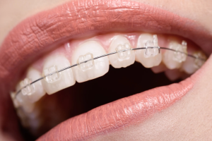 Clear Ceramic Braces