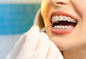 Clear Ceramic Braces