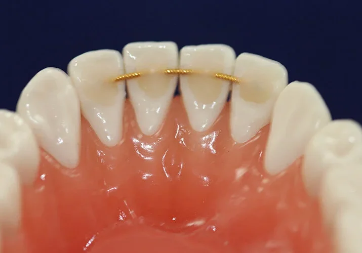 Bonded+retainer Bonded+retainer